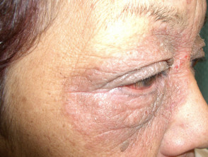 Dermatitis de contacto del párpado