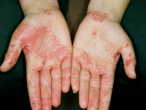Dermatitis de la mano en un granjero