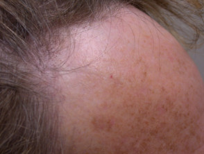 Alopecia fibrosante