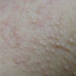 fibrofollic2__protectwyjqcm90zwn0il0_focusfillwzi5ncwymjisinkildnd-9843638-7000422-jpg-7368334