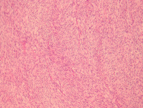 Patología del fibrosarcoma