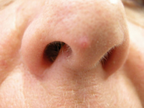 Pápula fibrosa de la nariz