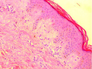 Histología de la amiloidosis cutis discrómica.  H + E