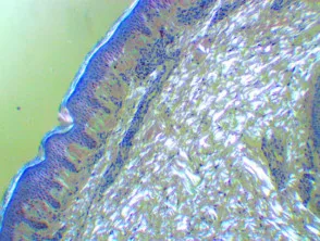 Histologie der Amyloidosis cutis dyschromia. Kongorot polarisiert