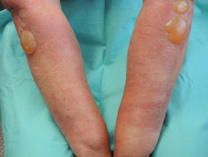 Dermatitis por higos