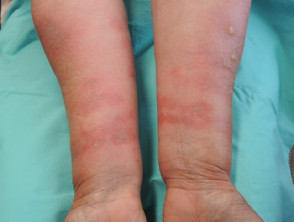 Dermatitis por higos