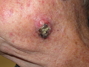 Carcinoma de células escamosas
