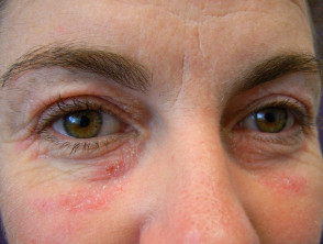 Eczema de contacto alérgico