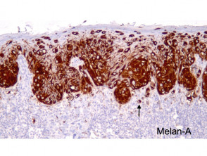Melanoma in situ: tinción Melan-A