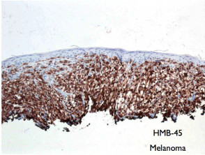 Inmunotinción melanocítica - HMB-45