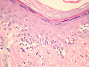 Patología del melanoma: melanoma lentiginoso