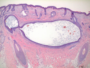 Patología primaria de la amiloidosis cutánea