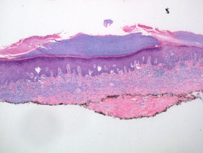 figure1porokeratosis__protectwyjqcm90zwn0il0_focusfillwzi5ncwymjisingildfd-3768731-8538002-jpg-8337789