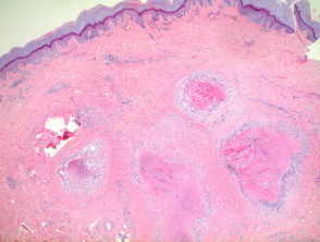 figure1rheumatoidenodule__protectwyjqcm90zwn0il0_focusfillwzi5ncwymjisingildfd-1663372-3055339-jpg-5297852