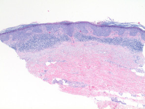 Patología in situ del carcinoma de células escamosas