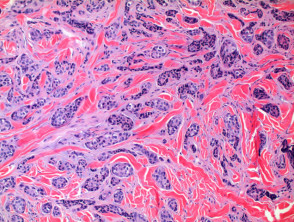 Patología del adenocarcinoma metastásico cutáneo