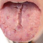 fissured-tongue__protectwyjqcm90zwn0il0_focusfillwzi5ncwymjisingildfd-1209084-1058235-jpg-2444880