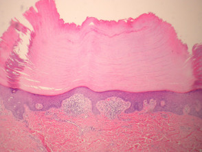 Patología de la hiperqueratosis lenticularis perstans (enfermedad de Flegel)