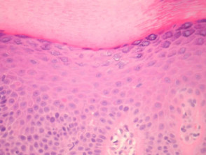 Patología de la hiperqueratosis lenticularis perstans (enfermedad de Flegel)