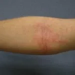 flexural-eczema01__protectwyjqcm90zwn0il0_focusfillwzi5ncwymjisingildfd-3414838-1287007-jpg-3331381