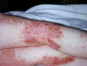 Dermatitis atópica