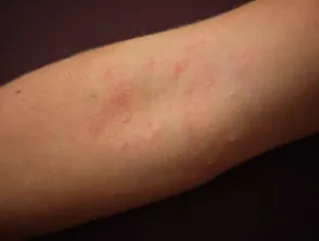 Dermatitis atópica