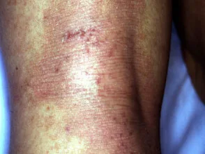 Dermatitis atópica