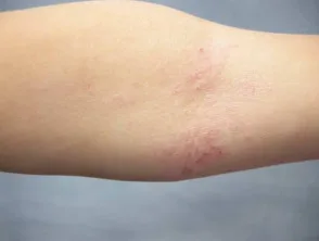 Dermatitis atópica