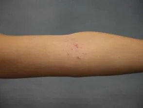 Dermatitis atópica