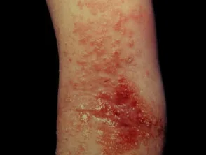 Dermatitis atópica