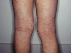 Dermatitis atópica