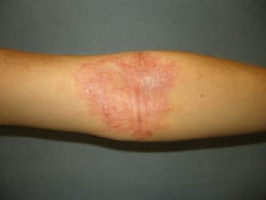 Dermatitis atópica