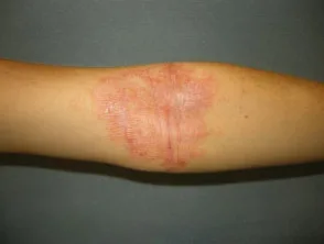 Dermatitis atópica