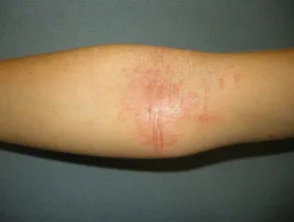 Dermatitis atópica