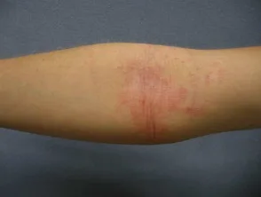 Dermatitis atópica