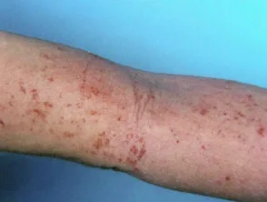 Dermatitis atópica