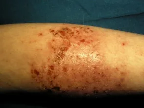 Dermatitis atópica