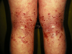 Dermatitis atópica