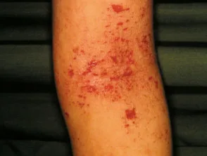 Dermatitis atópica