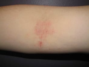 Atopische dermatitis