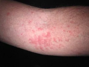 Dermatitis atópica