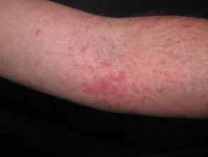 Dermatitis atópica