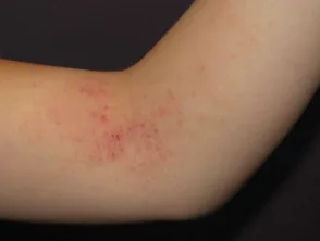 Dermatitis atópica