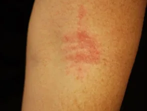 Dermatitis atópica