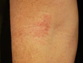 Dermatitis atópica