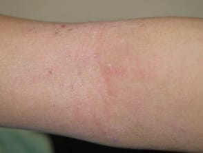 Atopische dermatitis