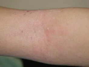 Dermatitis atópica