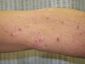 Dermatitis atópica