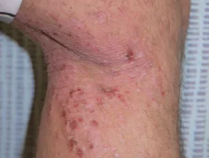 Dermatitis atópica