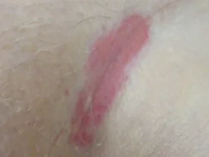 Biegepsoriasis